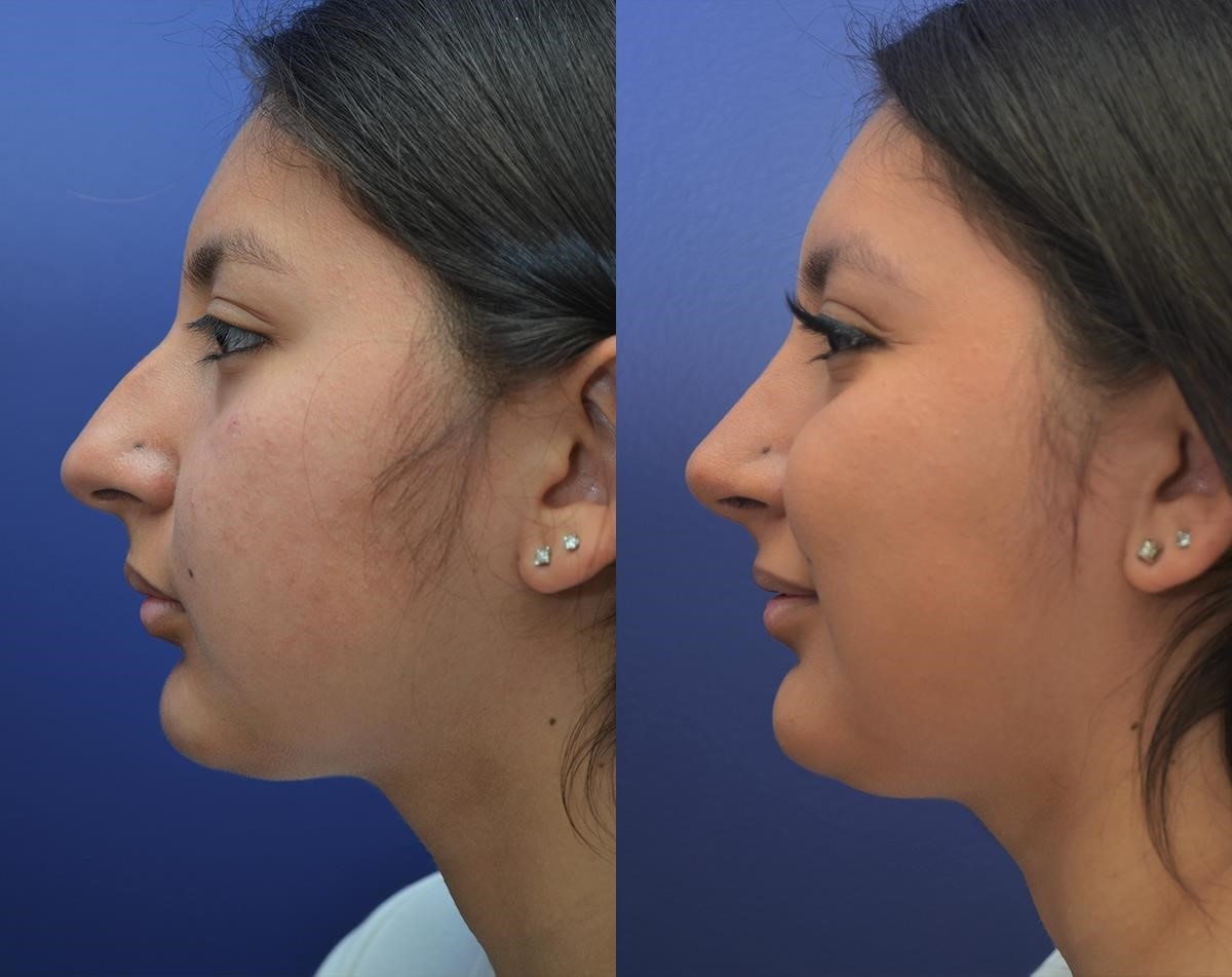 closed rhinoplasty near me