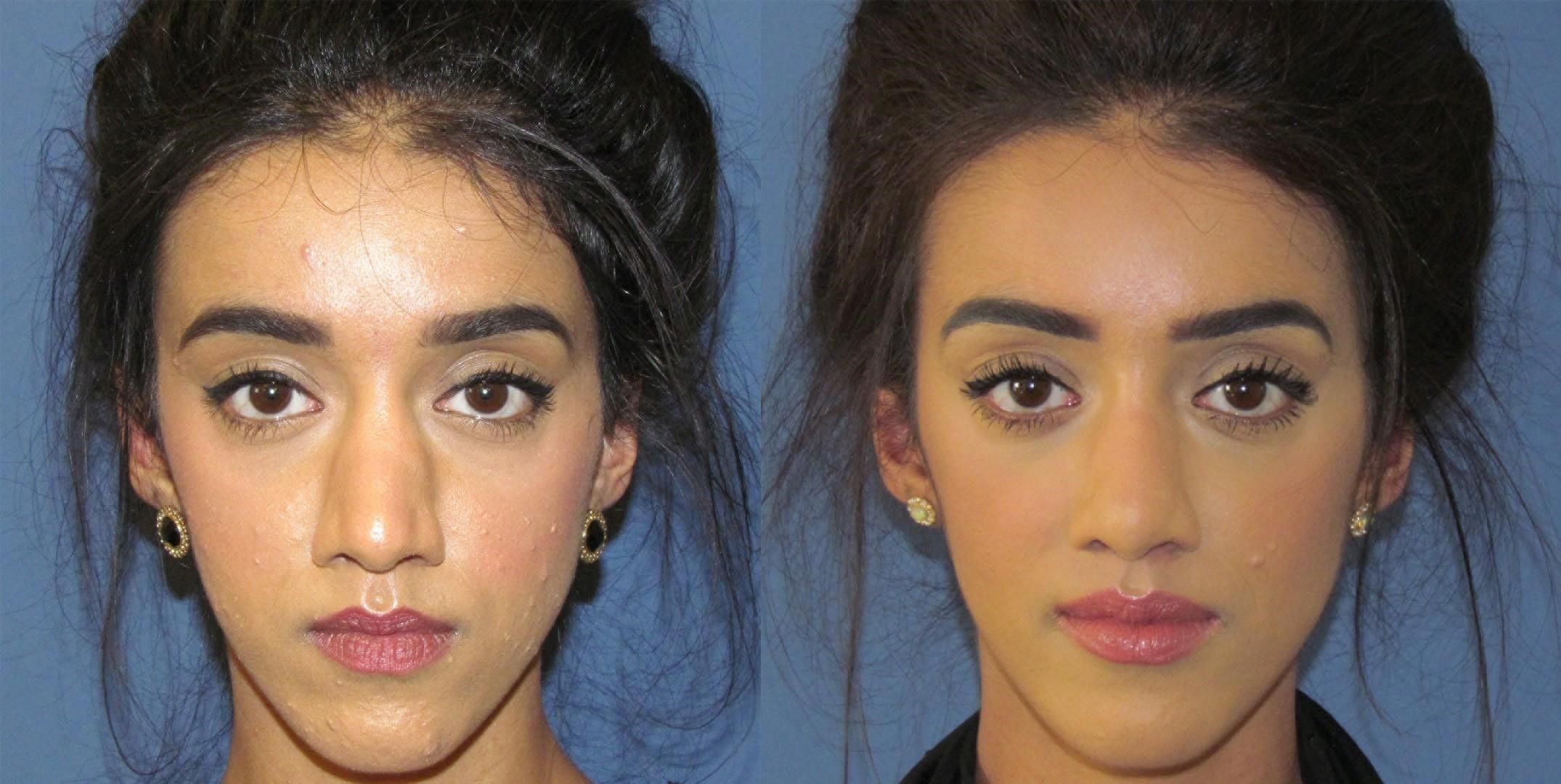 rhinoplasty surgeons near me